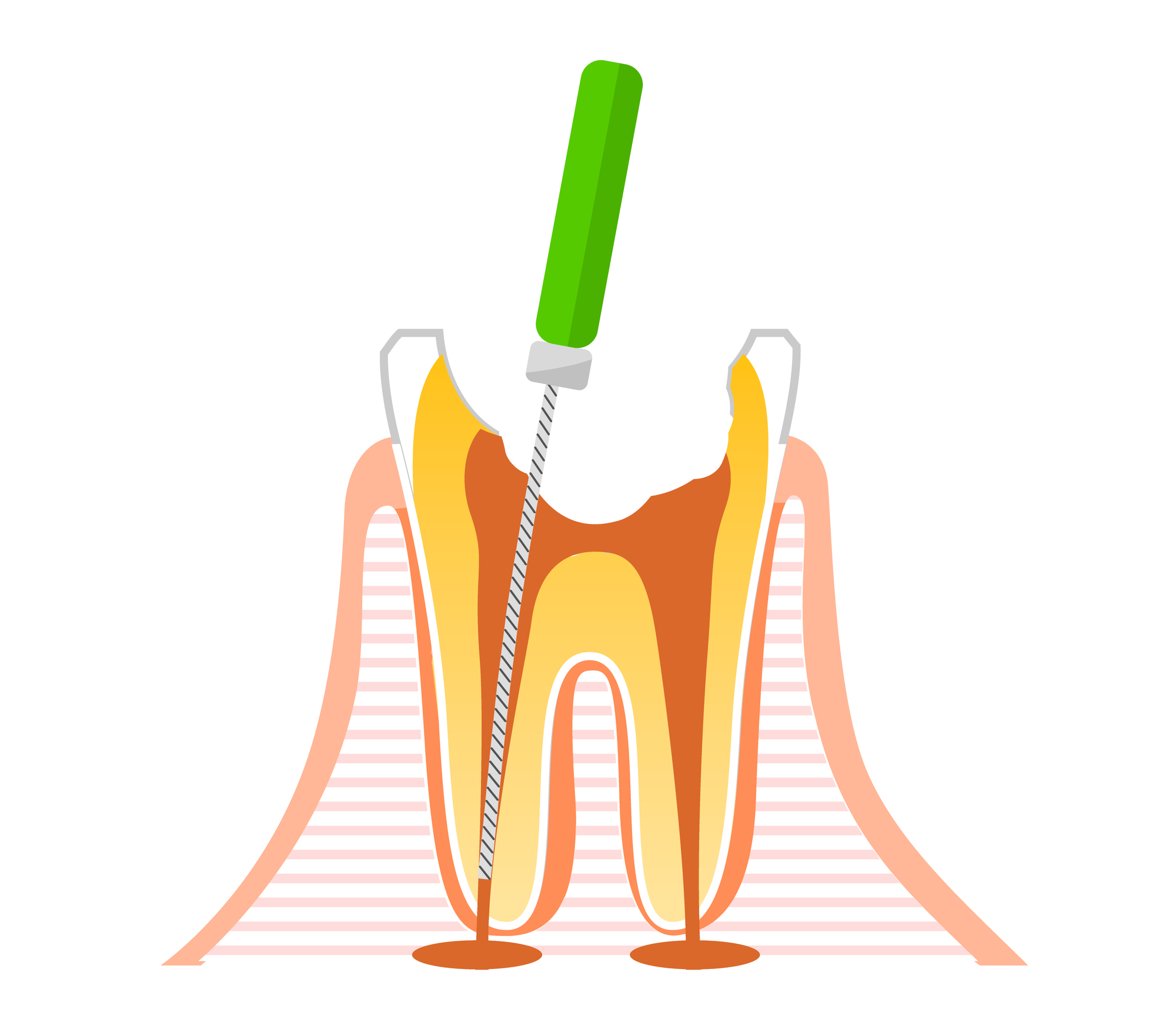 根管治療VSインプラントどちらを選ぶべきか？三好歯科 自由が丘歯科医師コラム、根管治療のイメージ