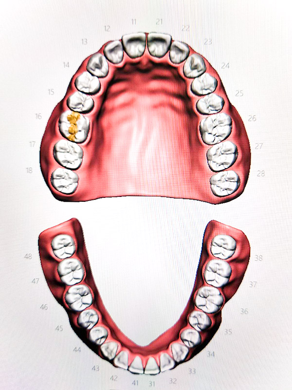 三好歯科 自由が丘｜ブログ｜2022年4月から保険適用「CADCAMインレー」について｜CADCAMインレーのイメージ画像3