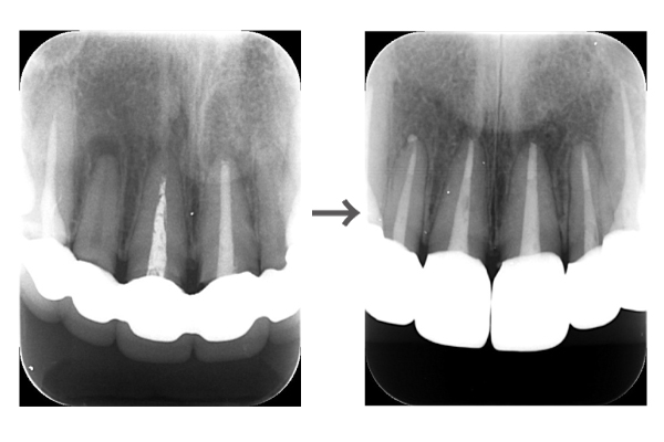 【症例】セラミック矯正により神経が死んだ歯の根管治療及び歯肉炎症等の総合的リカバリー