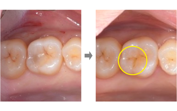 【症例】ダイレクトボンディングによる歯の修復と、コンポジットレジン（CR）修復（保険診療）との違いについて