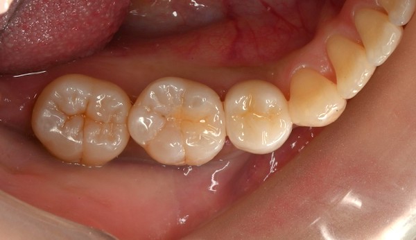 自由が丘の歯医者 三好歯科 自由が丘｜ブログ｜【症例】根管治療後にジルコニアクラウンとE-MAX（セラミック）インレーを装着｜詰め物・被せ物を合着した歯の画像