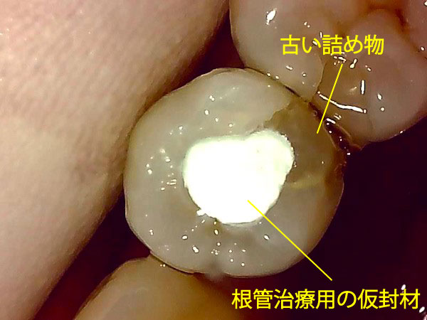 自由が丘の歯医者 三好歯科 自由が丘｜ブログ｜【症例】根管治療後にジルコニアクラウンとE-MAX（セラミック）インレーを装着｜仮封材を入れた歯の画像