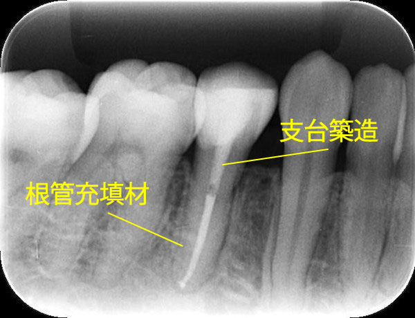 自由が丘の歯医者 三好歯科 自由が丘｜ブログ｜【症例】根管治療後にジルコニアクラウンとE-MAX（セラミック）インレーを装着｜根管治療後の歯のレントゲン画像