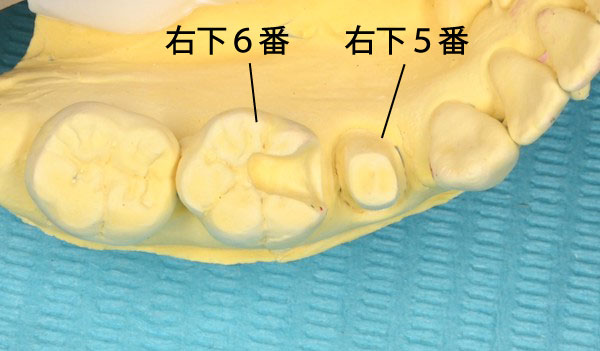 自由が丘の歯医者 三好歯科 自由が丘｜ブログ｜【症例】根管治療後にジルコニアクラウンとE-MAX（セラミック）インレーを装着｜歯の石膏模型の画像