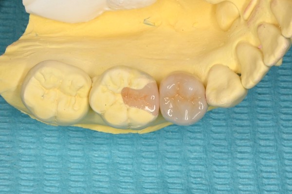 自由が丘の歯医者 三好歯科 自由が丘｜ブログ｜【症例】根管治療後にジルコニアクラウンとE-MAX（セラミック）インレーを装着｜被せ物を入れた歯の石膏模型の画像