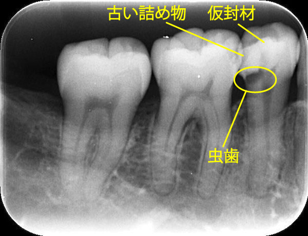 自由が丘の歯医者 三好歯科 自由が丘｜ブログ｜【症例】根管治療後にジルコニアクラウンとE-MAX（セラミック）インレーを装着｜治療前のレントゲン画像