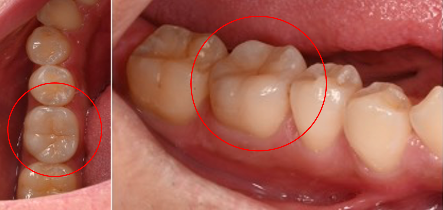 【症例】虫歯や欠損のある奥歯に対してセラミックアンレーによる修復治療を行った症例