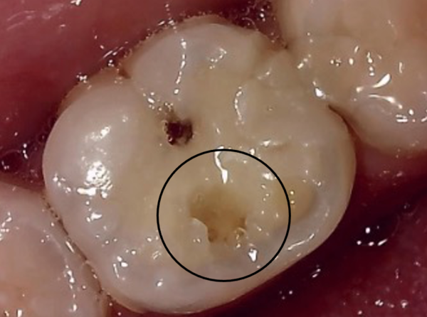 自由が丘の歯医者 三好歯科 自由が丘｜ブログ｜【症例】虫歯や欠損のある奥歯に対してセラミックアンレーによる修復治療を行った症例 ｜治療前4