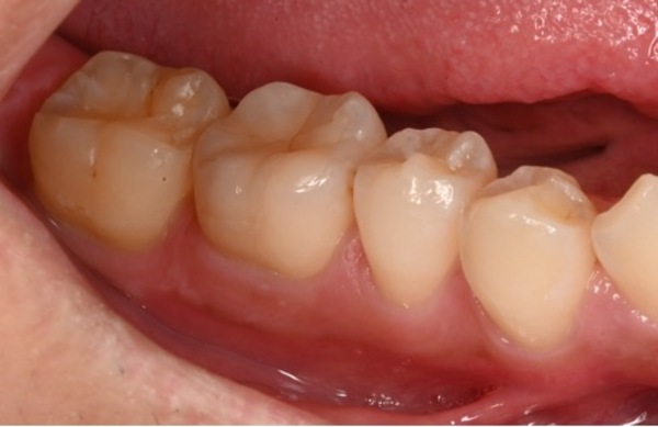 自由が丘の歯医者 三好歯科 自由が丘｜ブログ｜【症例】虫歯や欠損のある奥歯に対してセラミックアンレーによる修復治療を行った症例 ｜治療後2