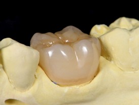 クラウン制作の為の型取り｜【症例】虫歯が原因で欠けたセラミックインレーに対するフルジルコニアクラウン治療｜自由が丘の歯医者 「三好歯科 自由が丘」
