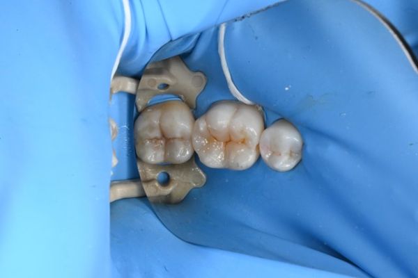 コンポッドレジン充填後画像｜【症例】虫歯になってしまった歯と隣の歯の古い詰め物をダイレクトボンディングで治療｜自由が丘の歯医者 三好歯科 自由が丘