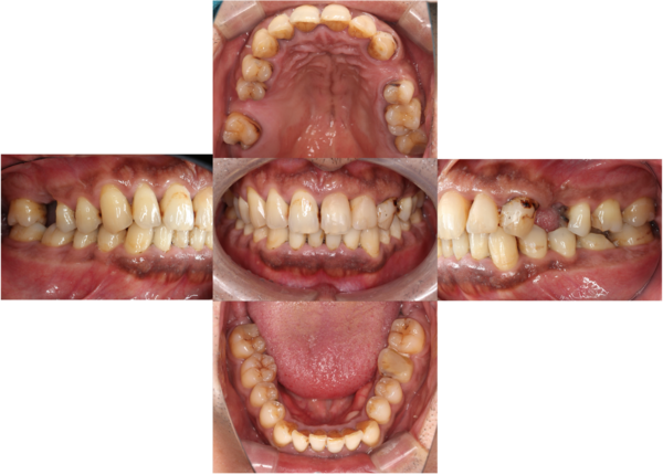 治療前口腔内画像｜【症例】問題のある部位のみの治療VS全体を見据えた治療計画｜自由が丘の歯医者 三好歯科 自由が丘