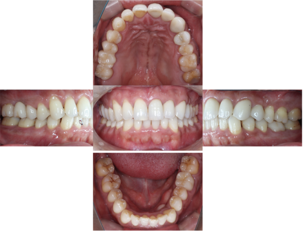 治療後口腔内画像｜【症例】問題のある部位のみの治療VS全体を見据えた治療計画｜自由が丘の歯医者 三好歯科 自由が丘