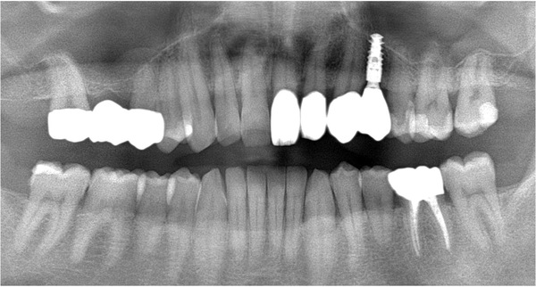 治療後レントゲン画像｜【症例】問題のある部位のみの治療VS全体を見据えた治療計画｜自由が丘の歯医者 三好歯科 自由が丘