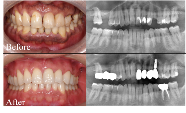 【症例】問題のある部位のみの治療VS全体を見据えた治療計画