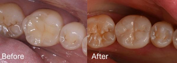 【症例】歯のひび割れ部分に対するオーバーレイ治療