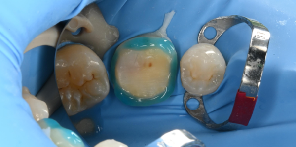 治療詳細画像7｜【症例】歯のひび割れ部分に対するオーバーレイ治療｜自由が丘の歯医者 三好歯科 自由が丘