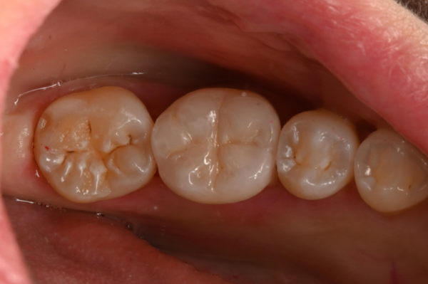 治療後画像1｜【症例】歯のひび割れ部分に対するオーバーレイ治療｜自由が丘の歯医者 三好歯科 自由が丘
