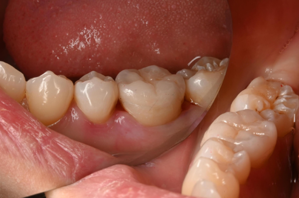 治療後画像2｜【症例】歯のひび割れ部分に対するオーバーレイ治療｜自由が丘の歯医者 三好歯科 自由が丘