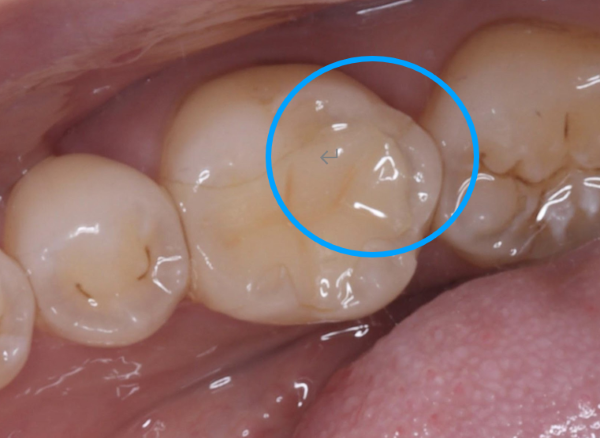 治療前画像｜【症例】歯のひび割れ部分に対するオーバーレイ治療｜自由が丘の歯医者 三好歯科 自由が丘