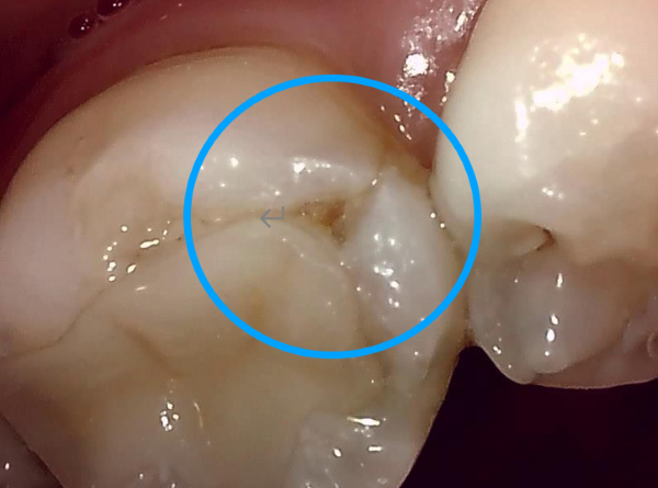 治療前画像2｜【症例】歯のひび割れ部分に対するオーバーレイ治療｜自由が丘の歯医者 三好歯科 自由が丘