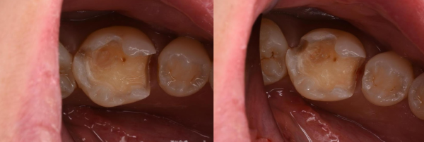 治療詳細画像3｜【症例】歯のひび割れ部分に対するオーバーレイ治療｜自由が丘の歯医者 三好歯科 自由が丘