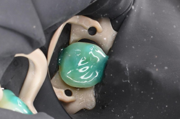 治療詳細画像4｜【症例】歯のひび割れ部分に対するオーバーレイ治療｜自由が丘の歯医者 三好歯科 自由が丘