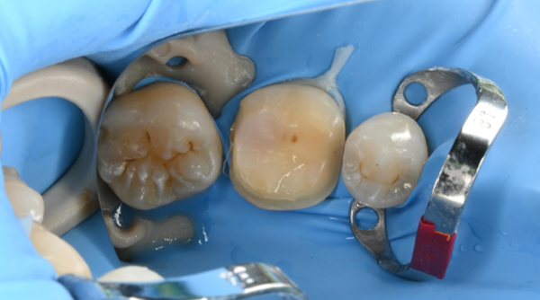 治療詳細画像6｜【症例】歯のひび割れ部分に対するオーバーレイ治療｜自由が丘の歯医者 三好歯科 自由が丘