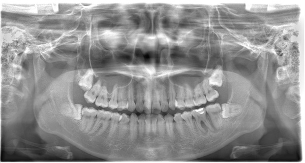 治療前口腔内レントゲン写真｜【症例】神経が壊死し、その周囲の骨が大きく欠損した歯への根管治療｜自由が丘の歯医者 三好歯科 自由が丘