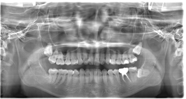 治療後1年3ヶ月後写真｜【症例】神経が壊死し、その周囲の骨が大きく欠損した歯への根管治療｜自由が丘の歯医者 三好歯科 自由が丘