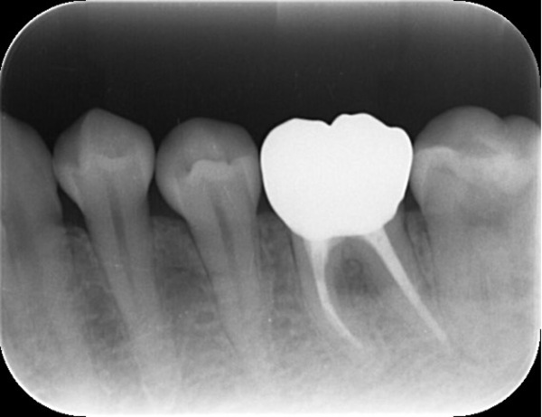 治療後詳細レントゲン写真｜【症例】神経が壊死し、その周囲の骨が大きく欠損した歯への根管治療｜自由が丘の歯医者 三好歯科 自由が丘