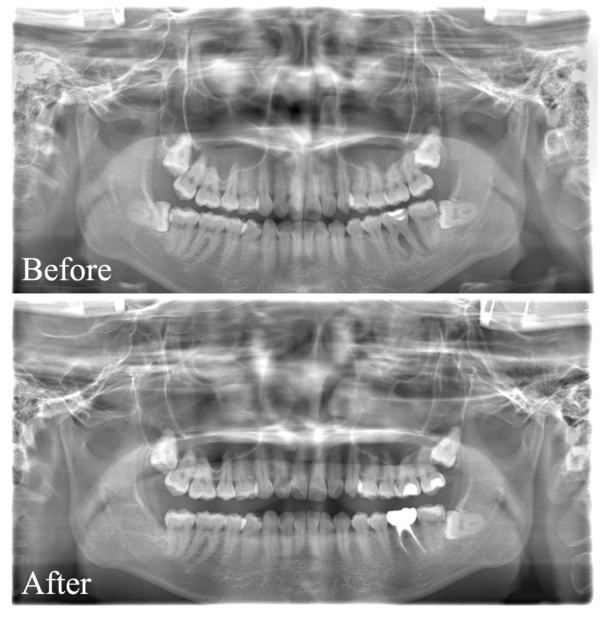 【症例】神経が壊死し、その周囲の骨が大きく欠損した歯への根管治療