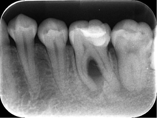 治療前詳細レントゲン写真｜【症例】神経が壊死し、その周囲の骨が大きく欠損した歯への根管治療｜自由が丘の歯医者 三好歯科 自由が丘