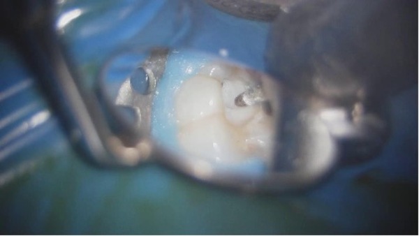 治療中以前の詰め物除去｜【症例】神経が壊死し、その周囲の骨が大きく欠損した歯への根管治療｜自由が丘の歯医者 三好歯科 自由が丘