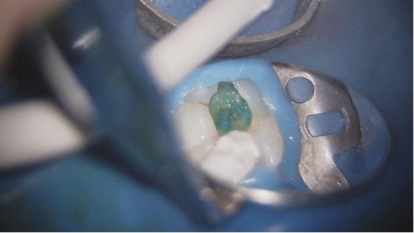 う蝕検出｜【症例】神経が壊死し、その周囲の骨が大きく欠損した歯への根管治療｜自由が丘の歯医者 三好歯科 自由が丘