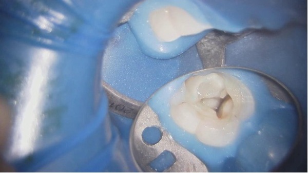 髄腔露出｜【症例】神経が壊死し、その周囲の骨が大きく欠損した歯への根管治療｜自由が丘の歯医者 三好歯科 自由が丘