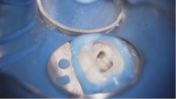 根管治療｜【症例】神経が壊死し、その周囲の骨が大きく欠損した歯への根管治療｜自由が丘の歯医者 三好歯科 自由が丘