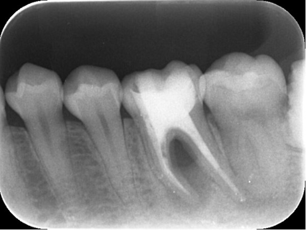 比較様初診時者写真｜【症例】神経が壊死し、その周囲の骨が大きく欠損した歯への根管治療｜自由が丘の歯医者 三好歯科 自由が丘
