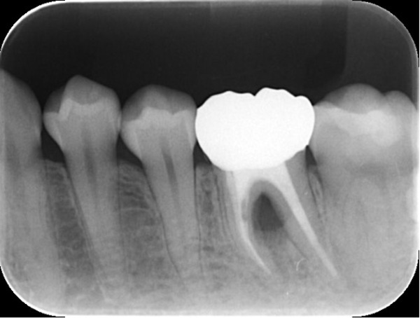 治療後６ヶ月｜【症例】神経が壊死し、その周囲の骨が大きく欠損した歯への根管治療｜自由が丘の歯医者 三好歯科 自由が丘