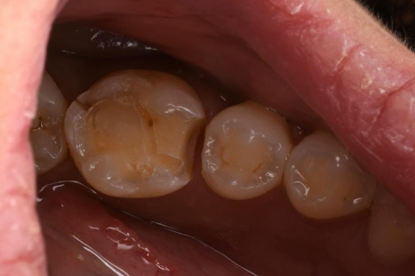 治療詳細画像2｜【症例】歯のひび割れ部分に対するオーバーレイ治療｜自由が丘の歯医者 三好歯科 自由が丘