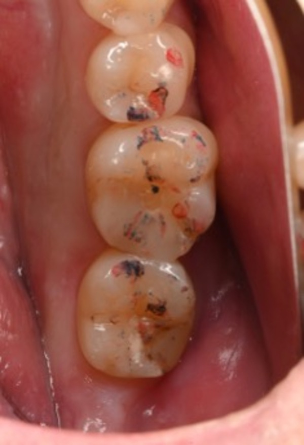 治療前画像1｜【症例】古い詰め物が劣化した歯に対するダイレクトボンディング治療｜自由が丘の歯医者 三好歯科 自由が丘