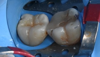 治療詳細画像6｜【症例】古い詰め物が劣化した歯に対するダイレクトボンディング治療｜自由が丘の歯医者 三好歯科 自由が丘