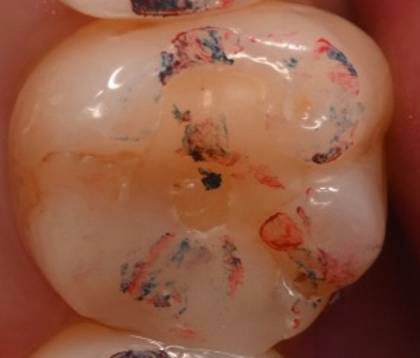 治療前画像2｜【症例】古い詰め物が劣化した歯に対するダイレクトボンディング治療｜自由が丘の歯医者 三好歯科 自由が丘