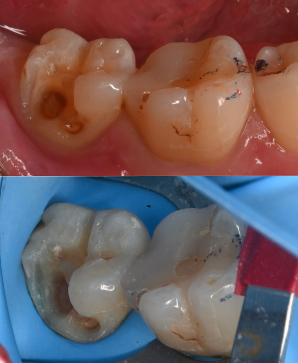 治療詳細画像1｜【症例】古い詰め物が劣化した歯に対するダイレクトボンディング治療｜自由が丘の歯医者 三好歯科 自由が丘