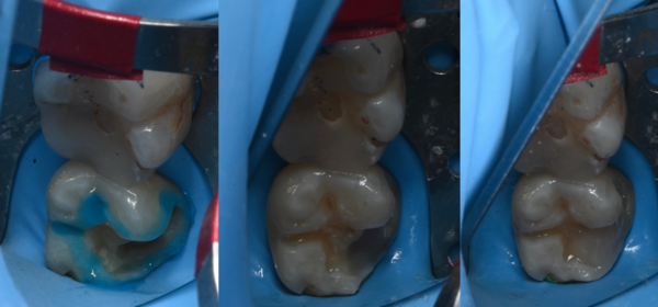 治療詳細画像2｜【症例】古い詰め物が劣化した歯に対するダイレクトボンディング治療｜自由が丘の歯医者 三好歯科 自由が丘