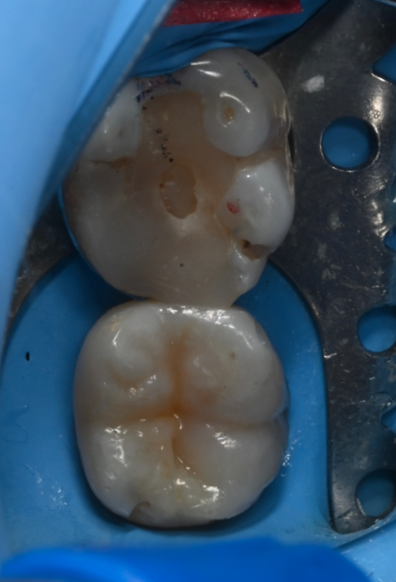 治療詳細画像3｜【症例】古い詰め物が劣化した歯に対するダイレクトボンディング治療｜自由が丘の歯医者 三好歯科 自由が丘