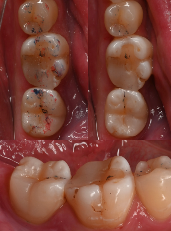 治療後画像｜【症例】古い詰め物が劣化した歯に対するダイレクトボンディング治療｜自由が丘の歯医者 三好歯科 自由が丘