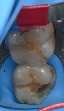 治療詳細画像4｜【症例】古い詰め物が劣化した歯に対するダイレクトボンディング治療｜自由が丘の歯医者 三好歯科 自由が丘