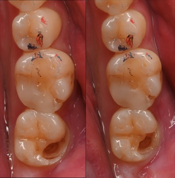 治療詳細画像5｜【症例】古い詰め物が劣化した歯に対するダイレクトボンディング治療｜自由が丘の歯医者 三好歯科 自由が丘