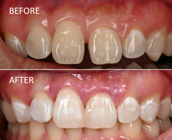 【症例】正中離開に対するダイレクトボンディング治療